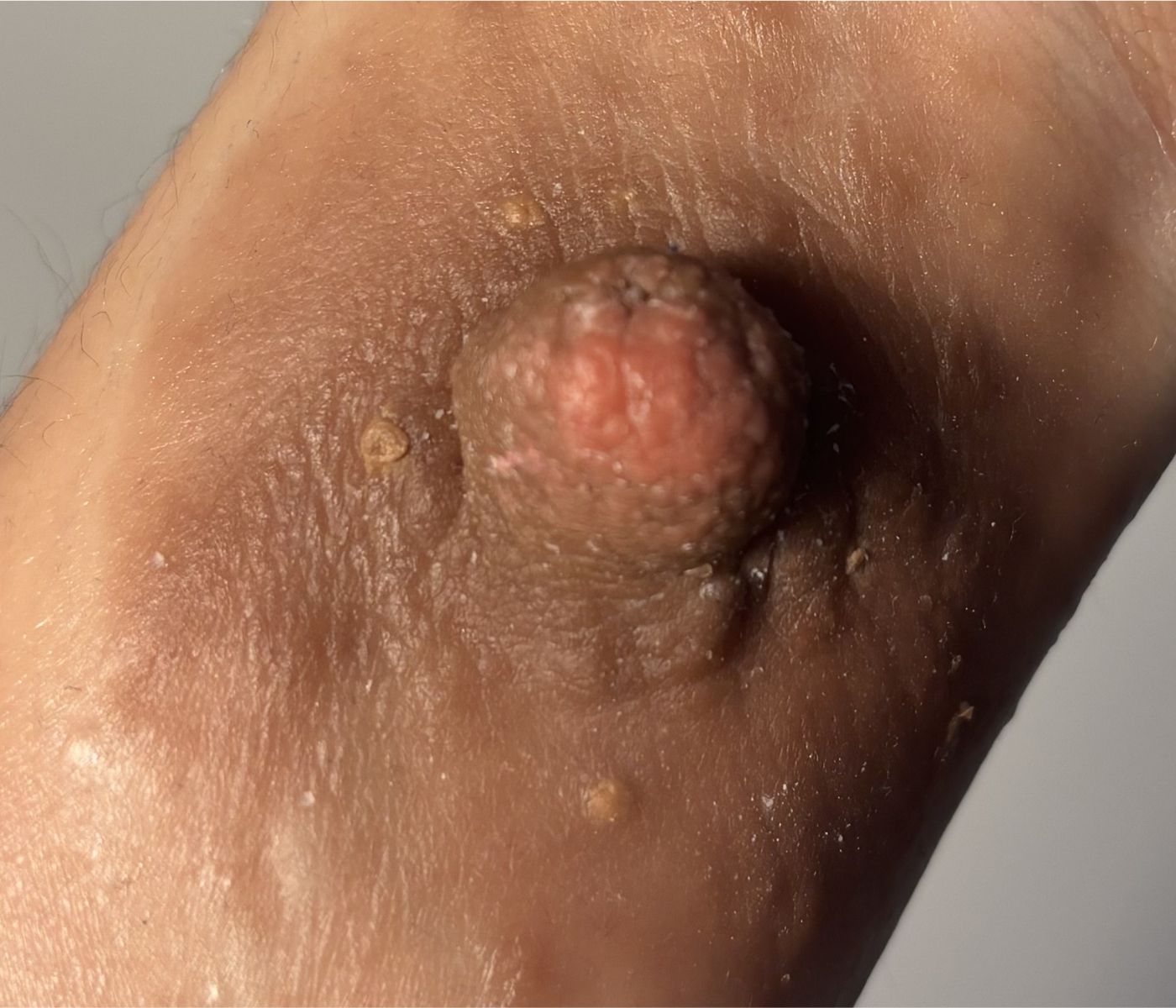 Foto de una prótesis de areola y pezón aplicada sobre la piel
